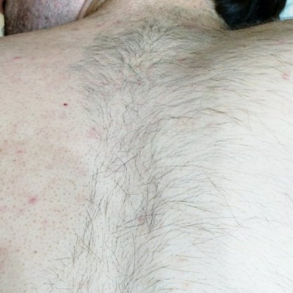 Before-plecy